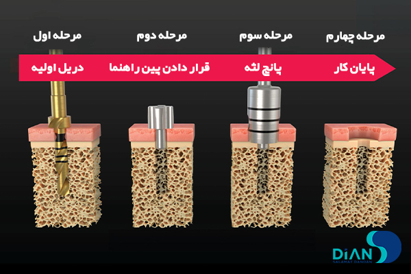 کاشت ایمپلنت به روش پانچ