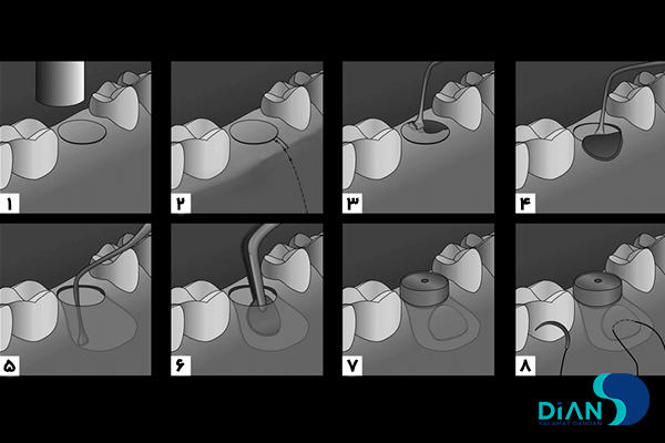کاشت ایمپلنت به روش پانچ