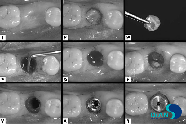 کاشت ایمپلنت به روش پانچ