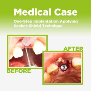 One-Step Implantation with Socket-Shield