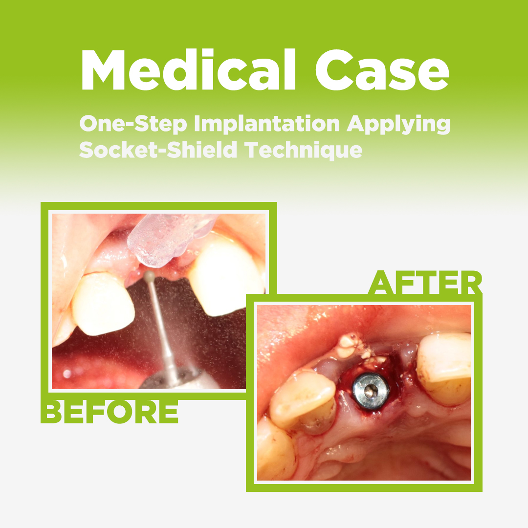 One-Step Implantation with Socket-Shield