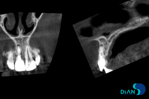 One Step Implantation with Socket Shield 