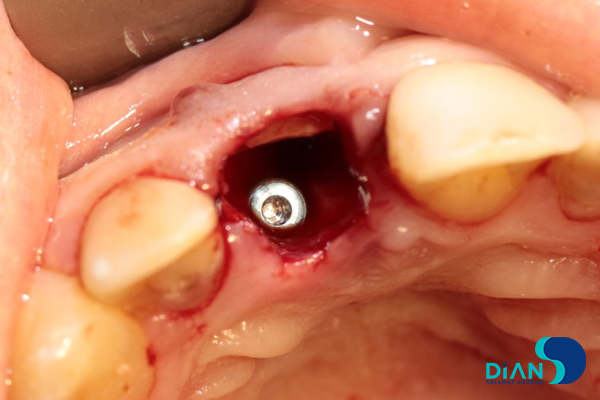 One Step Implantation with Socket Shield