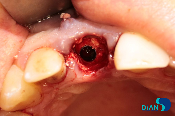 One Step Implantation with Socket Shield