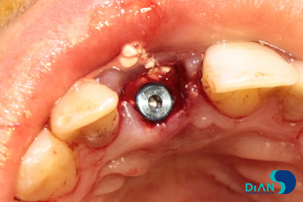 One Step Implantation with Socket Shield