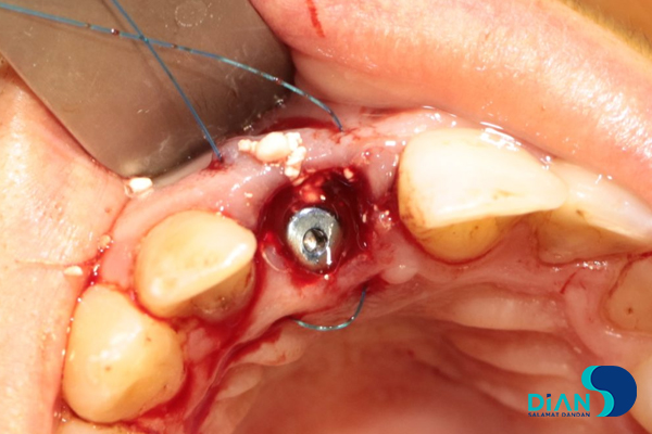 One Step Implantation with Socket Shield