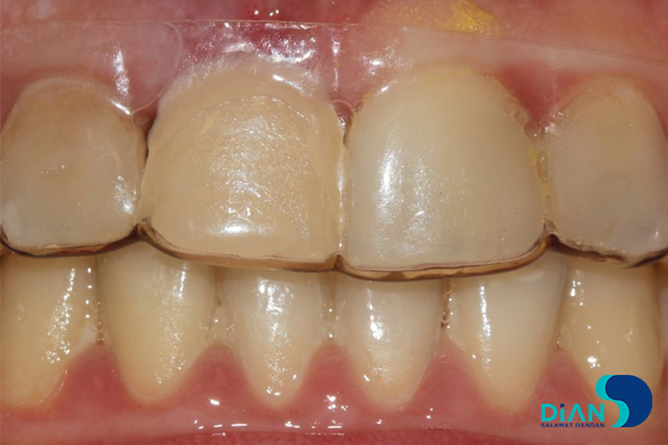 One Step Implantation with Socket Shield