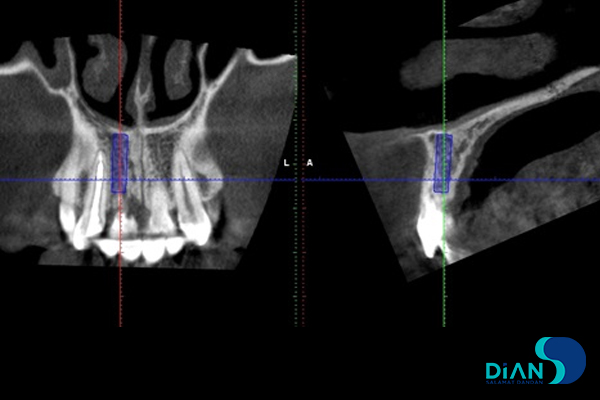 One Step Implantation with Socket Shield
