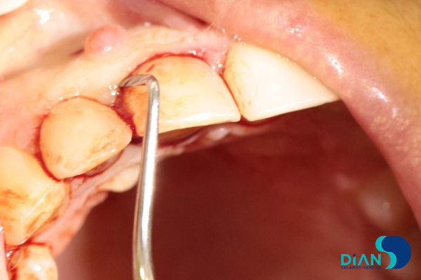 One Step Implantation with Socket Shield