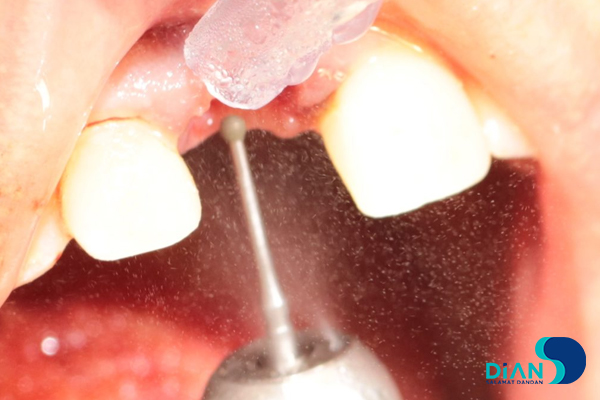 One Step Implantation with Socket Shield