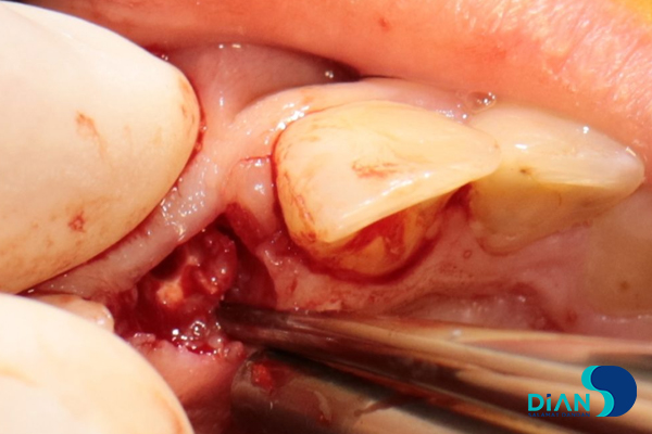 One Step Implantation with Socket Shield