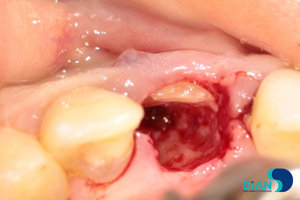 One Step Implantation with Socket Shield