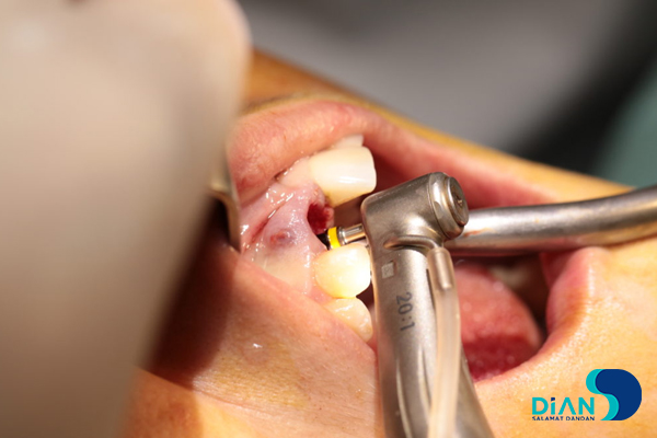 One Step Implantation with Socket Shield