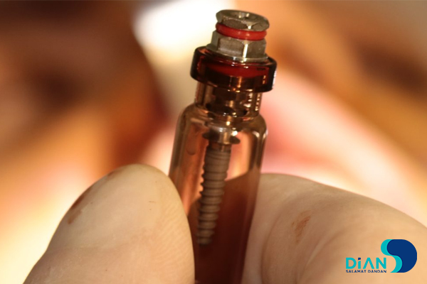 One Step Implantation with Socket Shield