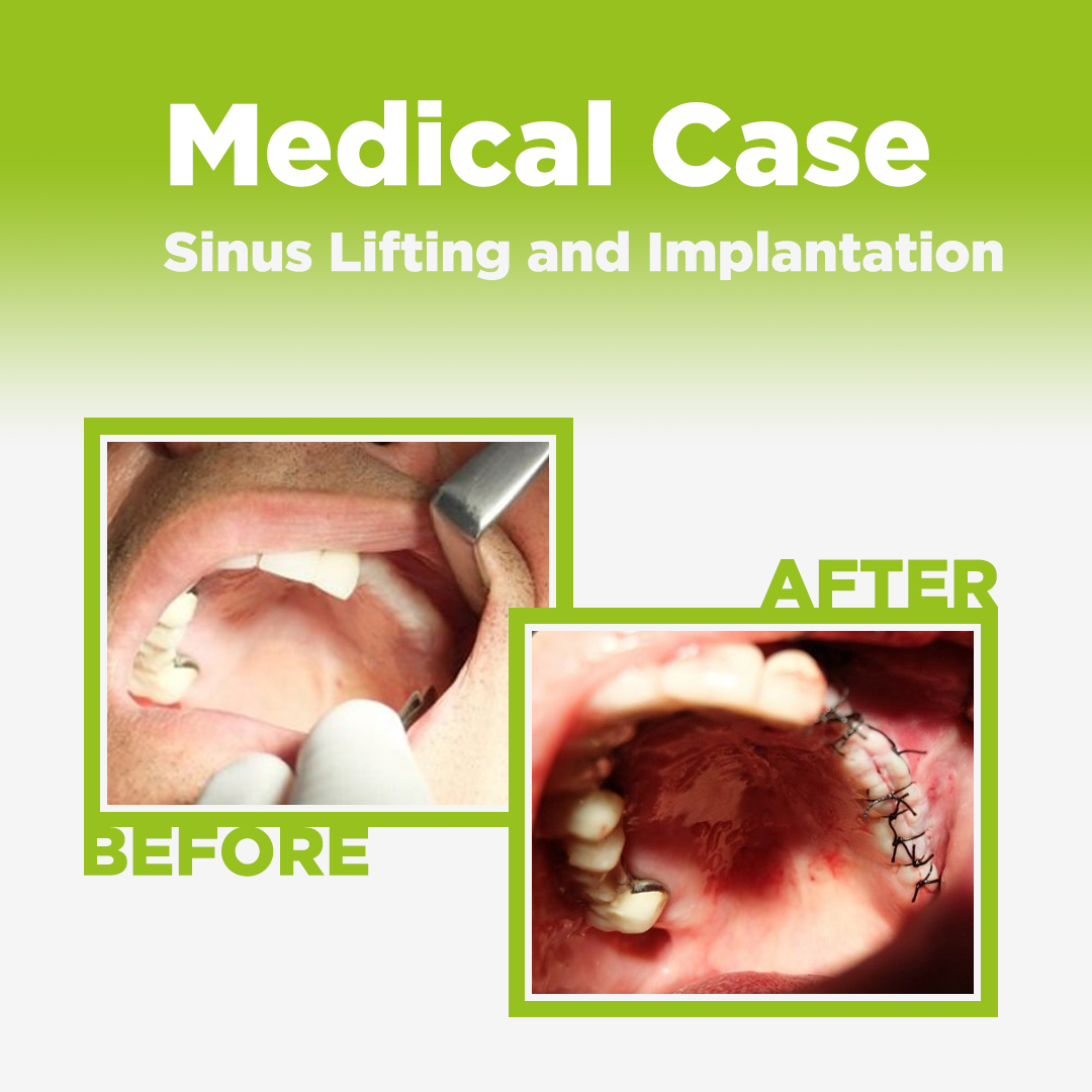 Sinus Lifting and Implantation