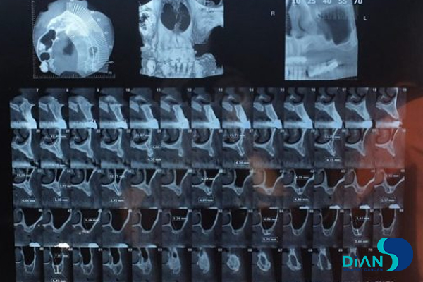 Sinus Lifting and Implantation