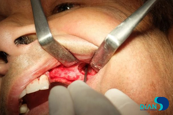 Sinus Lifting and Implantation