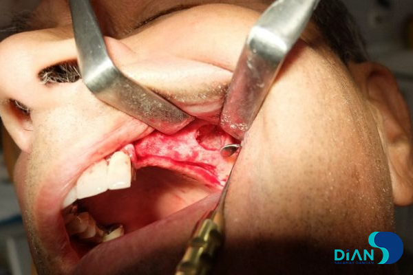 Sinus Lifting and Implantation