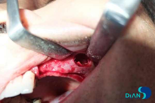 Sinus Lifting and Implantation