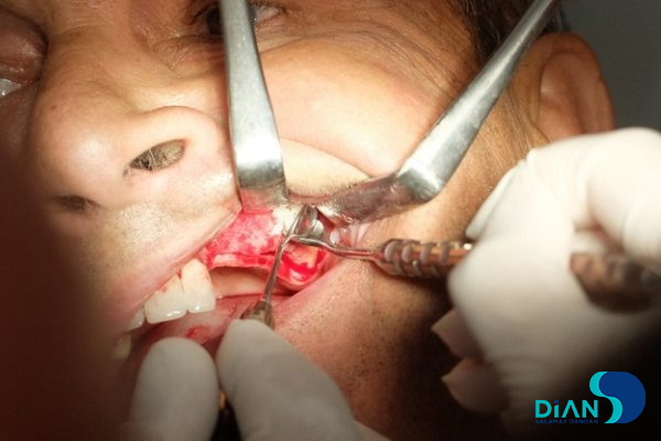 Sinus Lifting and Implantation