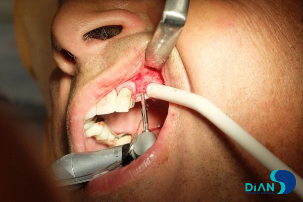 Sinus Lifting and Implantation