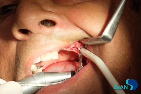 Sinus Lifting and Implantation