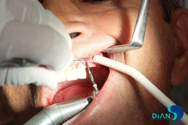 Sinus Lifting and Implantation