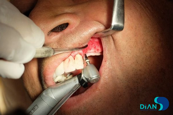 Sinus Lifting and Implantation