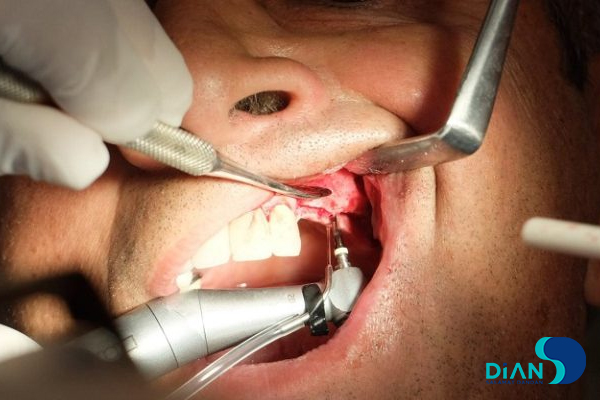 Sinus Lifting and Implantation