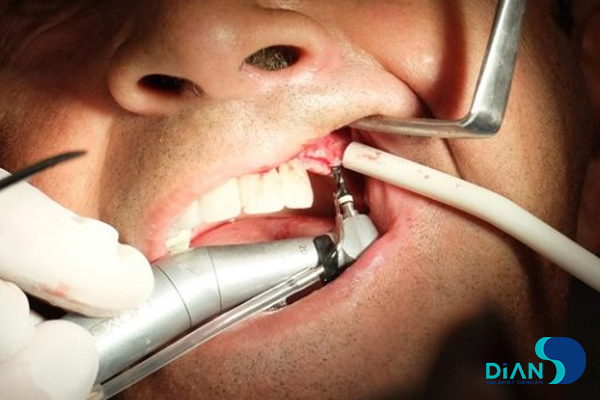 Sinus Lifting and Implantation