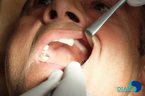 Sinus Lifting and Implantation