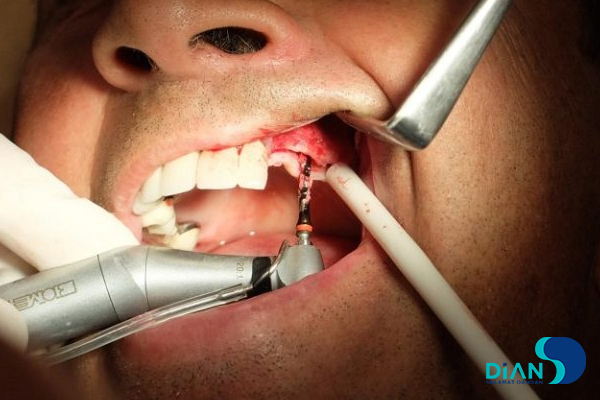 Sinus Lifting and Implantation