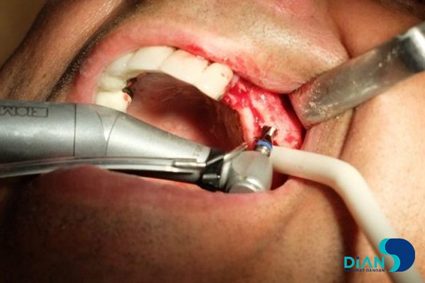 Sinus Lifting and Implantation