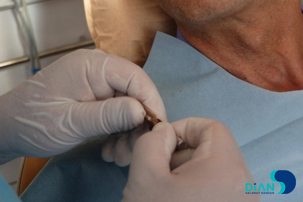 Sinus Lifting and Implantation
