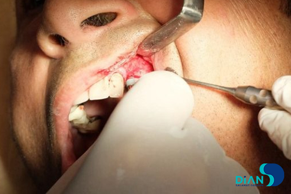 Sinus Lifting and Implantation
