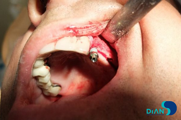 Sinus Lifting and Implantation