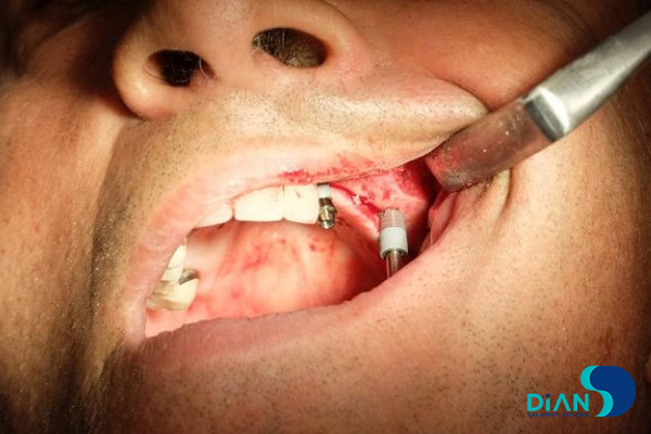 Sinus Lifting and Implantation