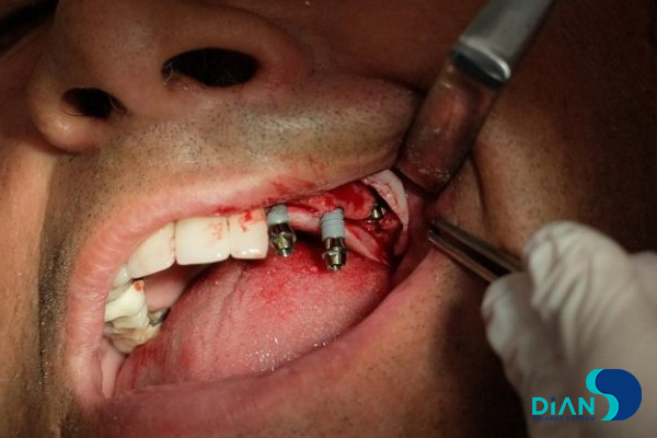 Sinus Lifting and Implantation