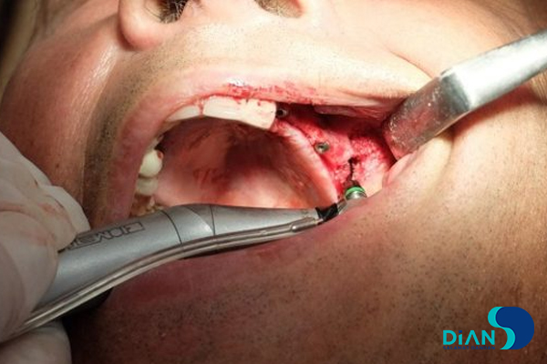 Sinus Lifting and Implantation