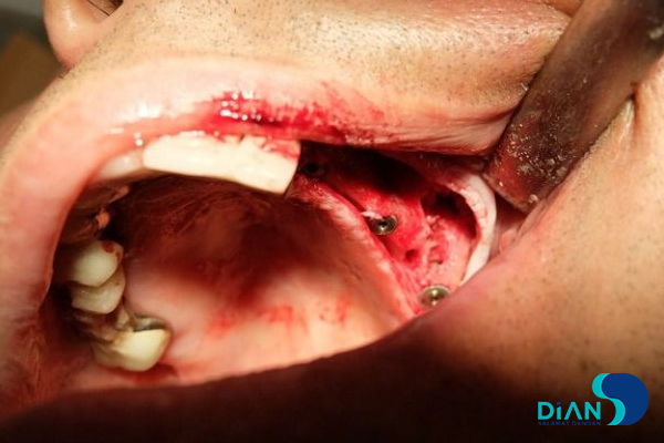 Sinus Lifting and Implantation