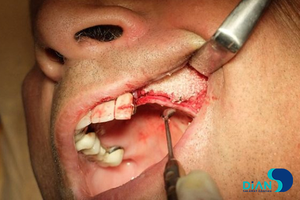 Sinus Lifting and Implantation