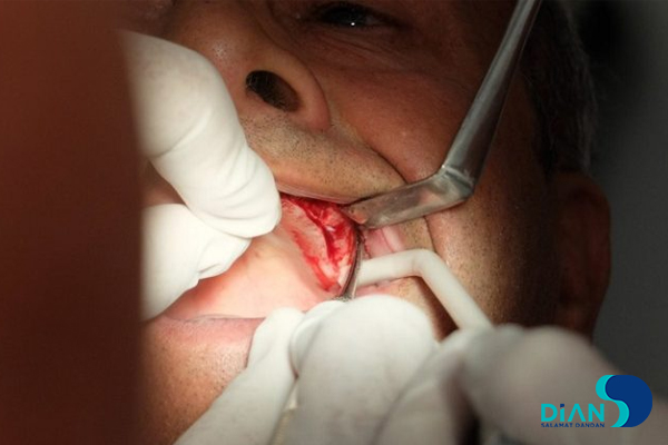 Sinus Lifting and Implantation
