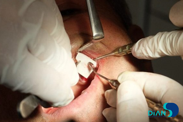 Sinus Lifting and Implantation