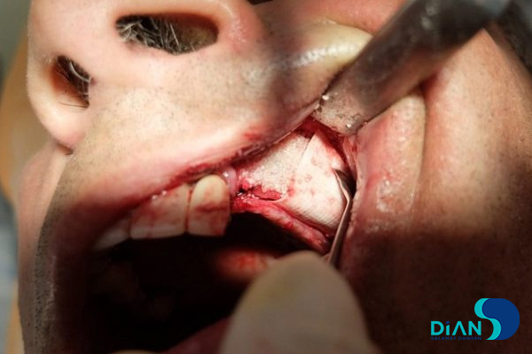 Sinus Lifting and Implantation
