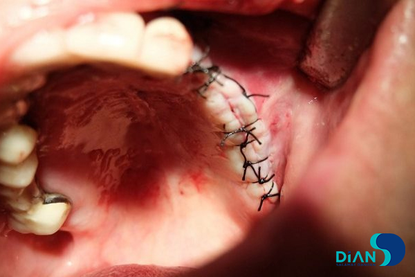 Sinus Lifting and Implantation