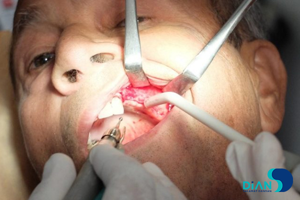 Sinus Lifting and Implantation