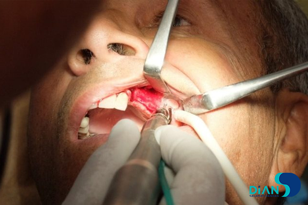 Sinus Lifting and Implantation