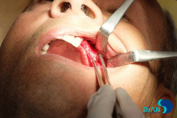 Sinus Lifting and Implantation
