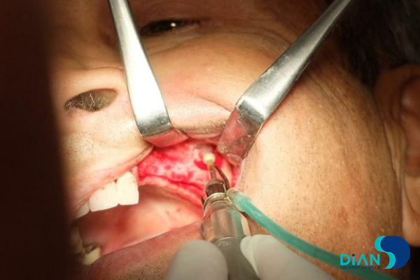Sinus Lifting and Implantation