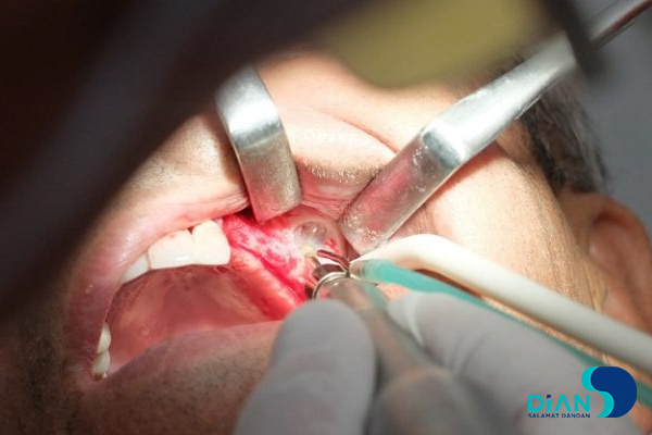 Sinus Lifting and Implantation
